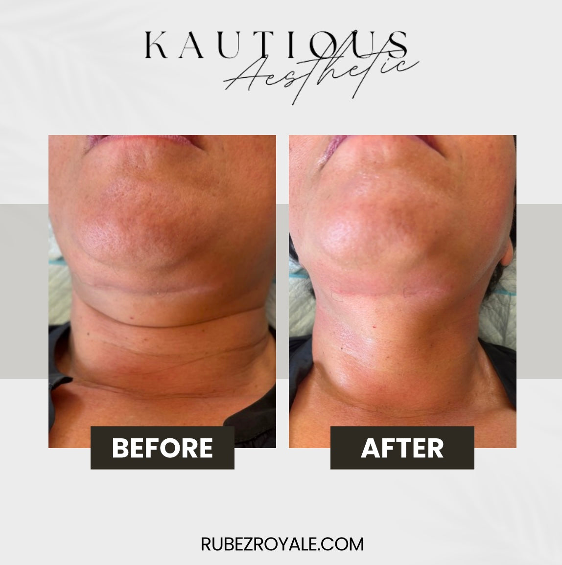 Double Chin/Loose Skin