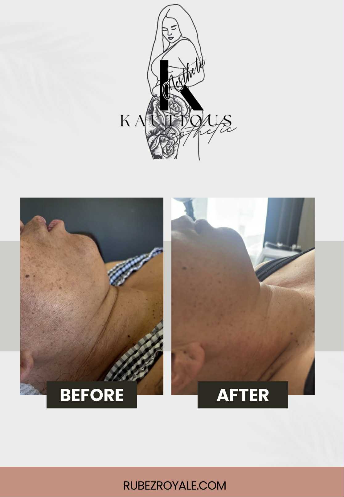 Double Chin/Loose Skin