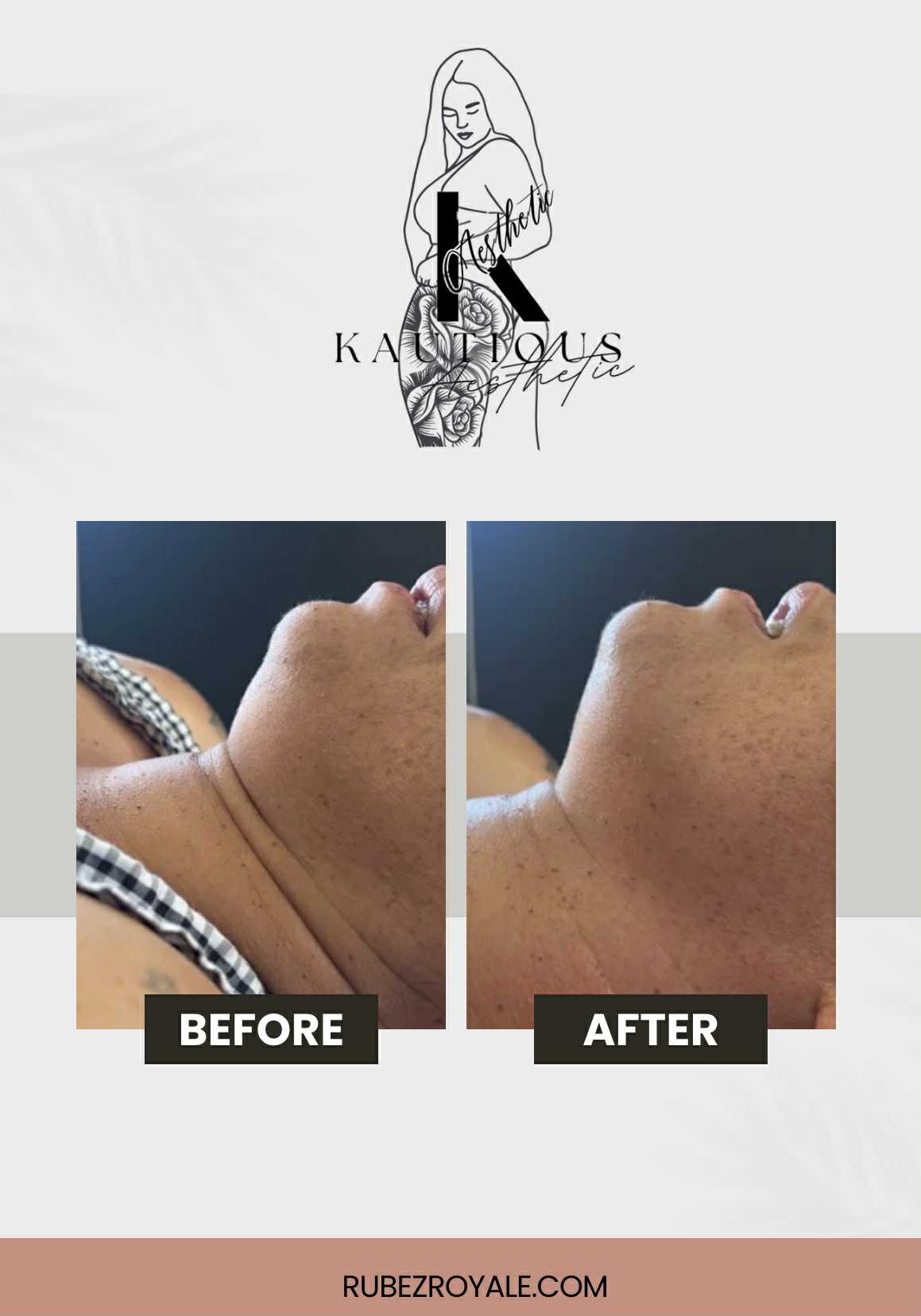 Double Chin/Loose Skin