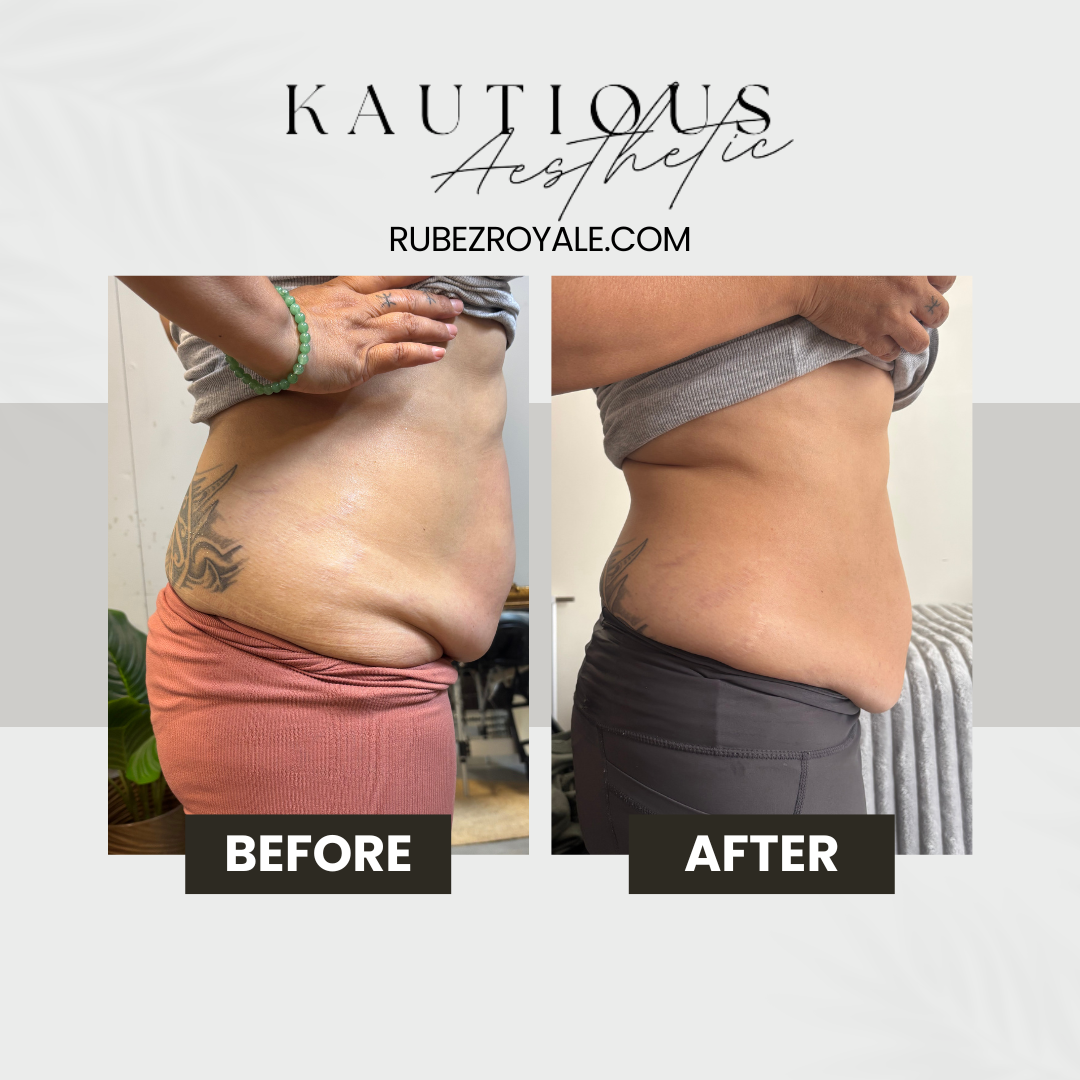 Mummy Tummy/Abdomin