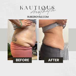 Mummy Tummy/Abdomin